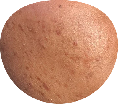 Cicatrices d’acné & imperfections