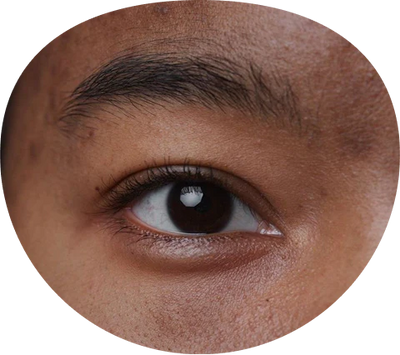Taches brunes & hyperpigmentation